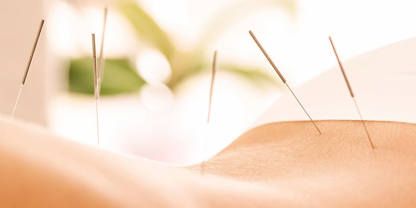 Akupunktur