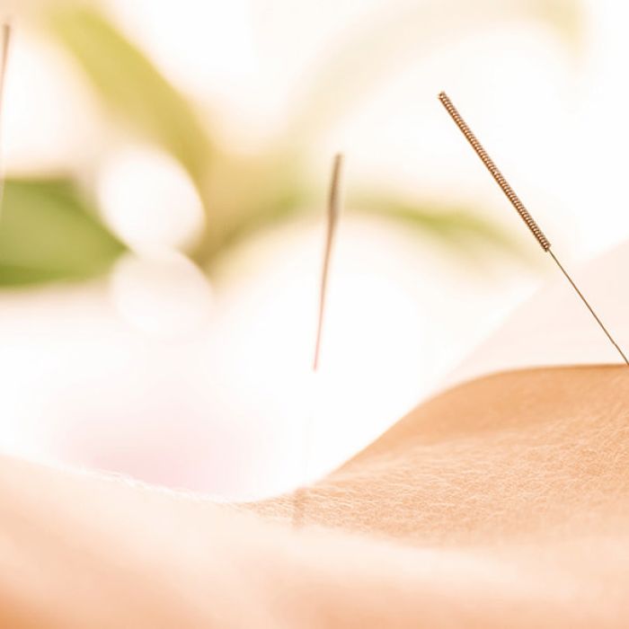 Akupunktur